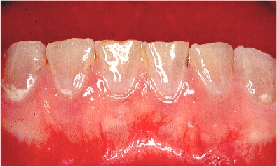 Dentinogenesisimp, Zahnaufhellung