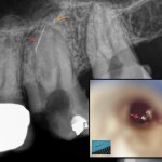 Fragment - Wurzelkanalbehandlungen mit Dentalmikroskop