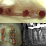 Kanale - Wurzelkanalbehandlungen mit Dentalmikroskop