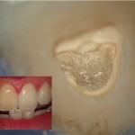 Obliteration - Wurzelkanalbehandlungen mit Dentalmikroskop