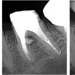 Perforation1 - Wurzelkanalbehandlungen mit Dentalmikroskop