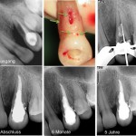 Replantation - Endodontische Mikrochirurgie