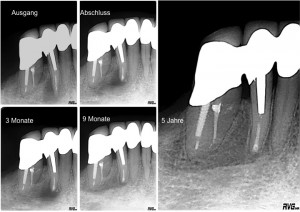 Endodontische Mikrochirurgie