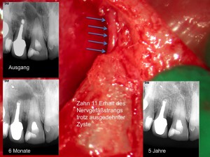 Zystektomie - Endodontische Mikrochirurgie